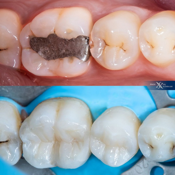 Amalgam-Smart-Protokolls