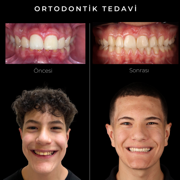 Kieferorthopädische Behandlung