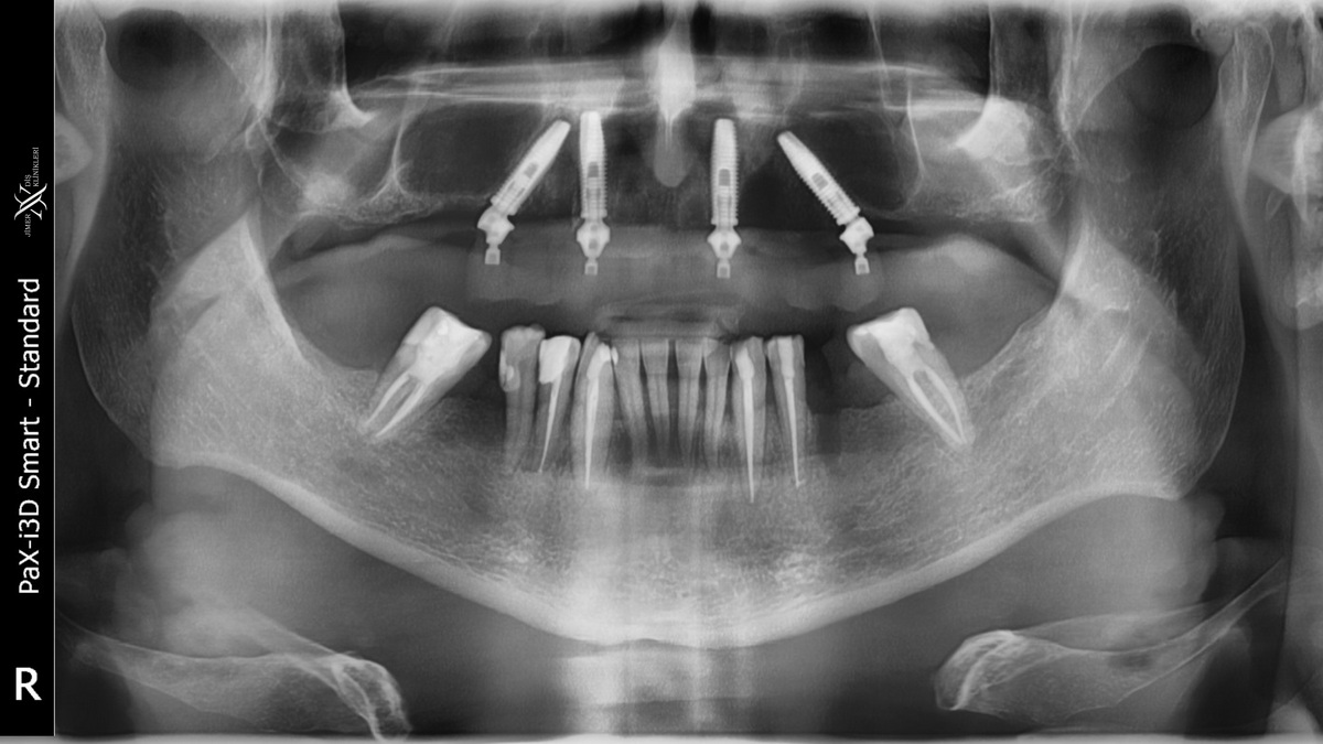 Was sind die Unterschiede zwischen Dentaltomographie und Panoramaröntgen?