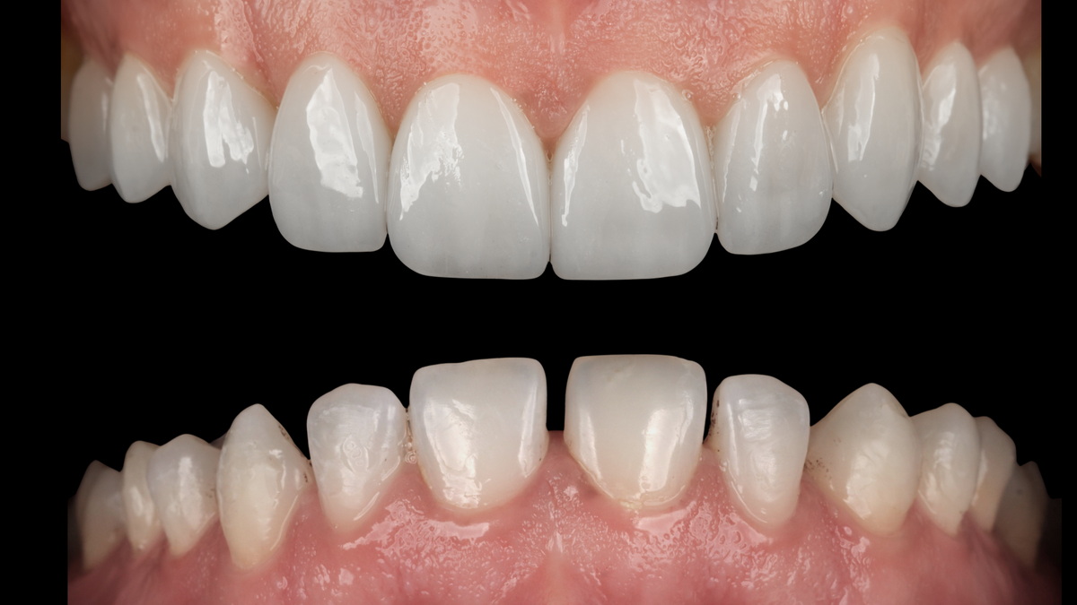 Laminat-Veneers (Blattporzellan-Veneers)