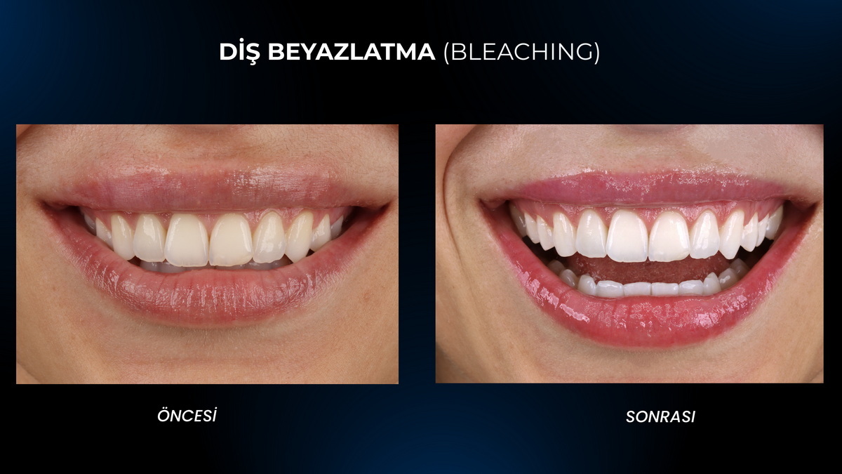 Bursa-Zahnaufhellung (Zahnbleaching)